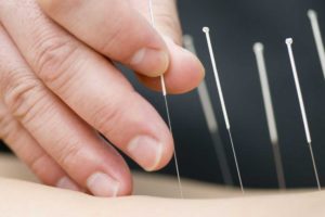 Dry Needling and Acupuncture